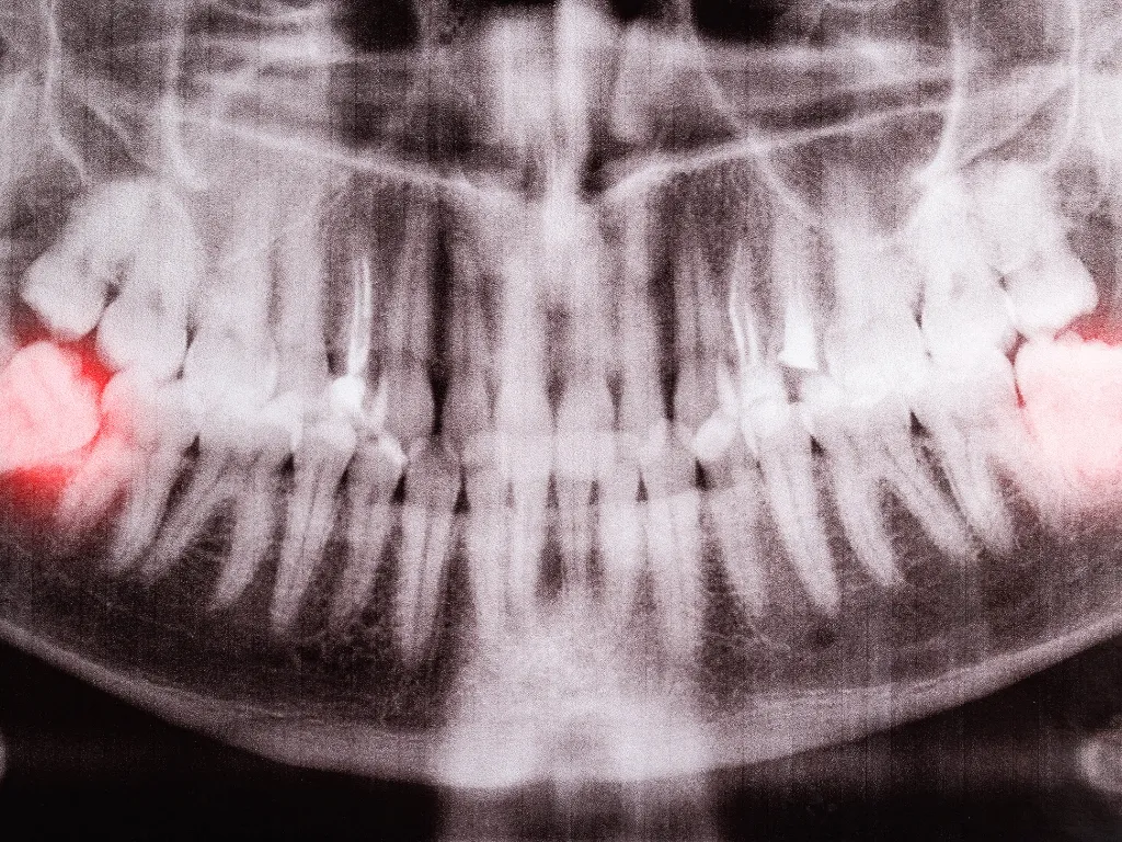 Why Waiting to Remove Wisdom Teeth Can Cost You More Why Waiting to Remove Wisdom Teeth Can Cost You More