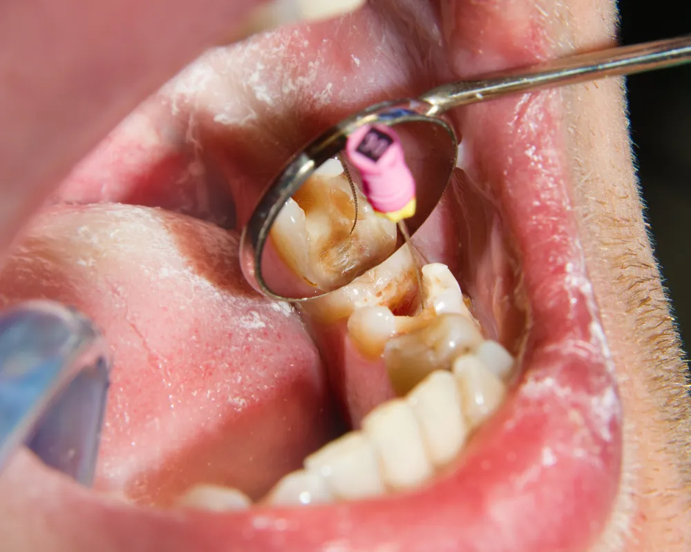 signs you need a root canal