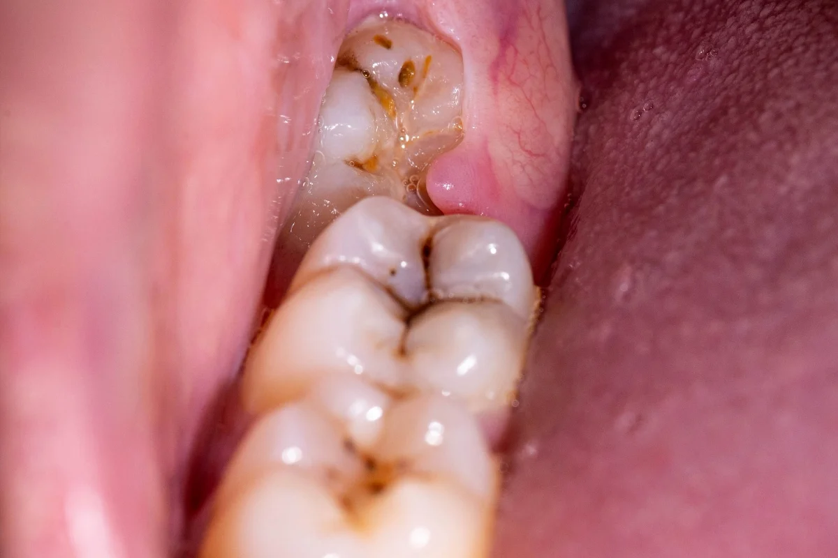 Common Reasons for Extracting a Tooth Common Reasons for Extracting a Tooth