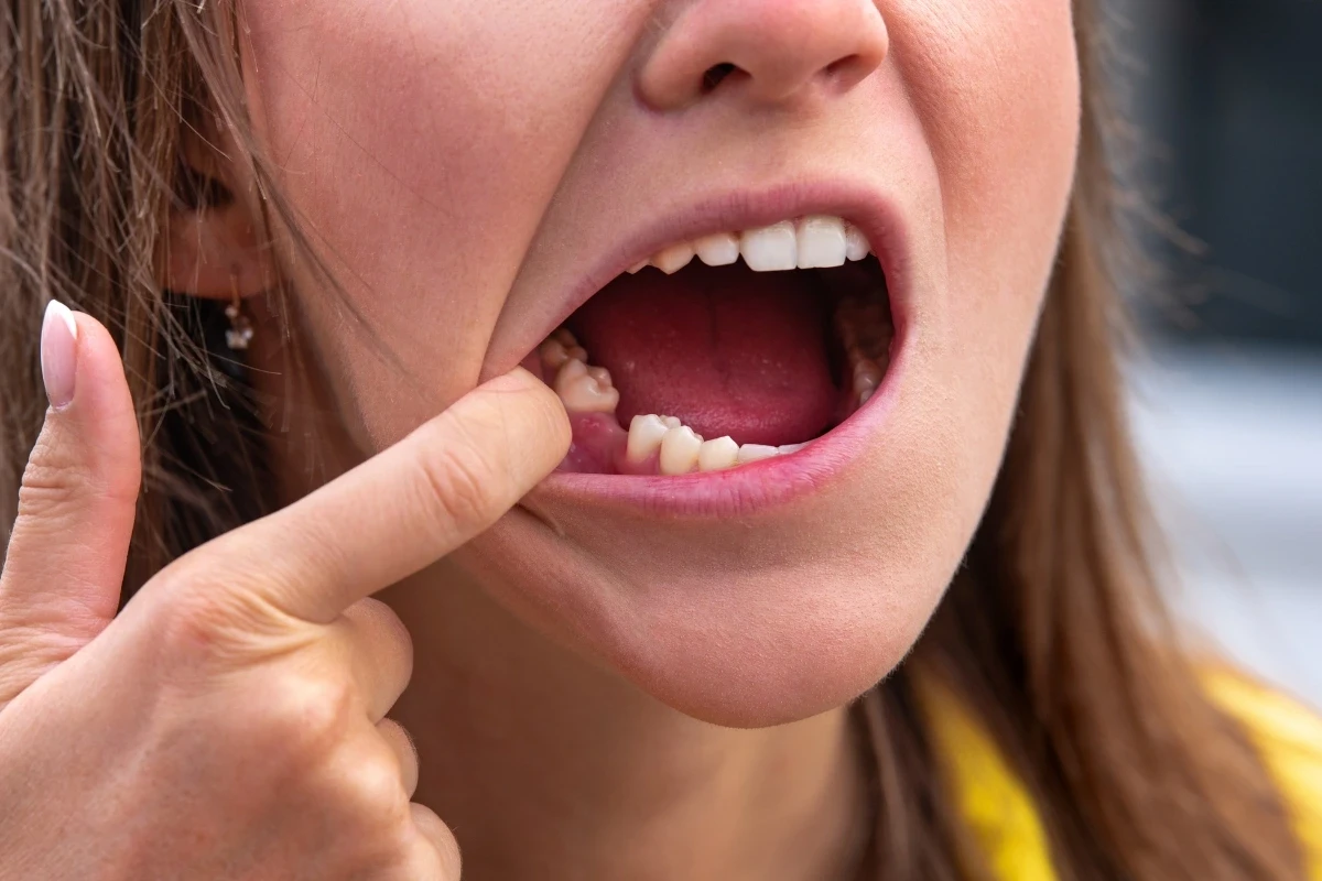 Is a Chipped Tooth a Dental Emergency Is a Chipped Tooth a Dental Emergency