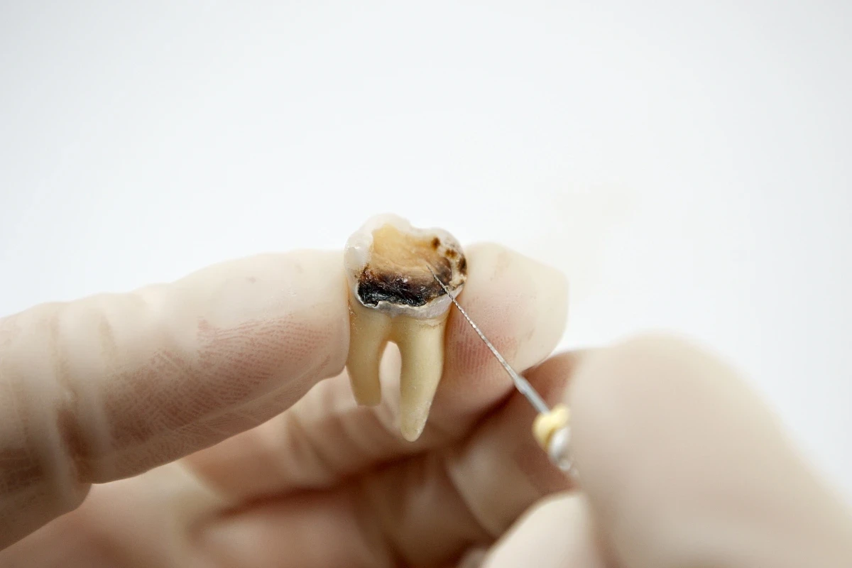 When Is a Chipped Tooth an Emergency When Is a Chipped Tooth an Emergency