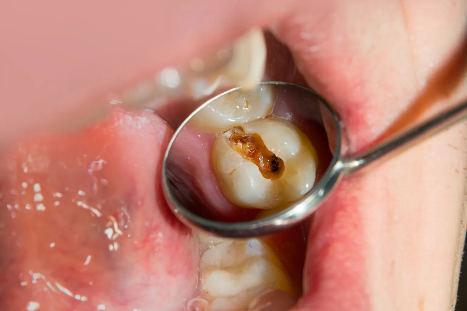 hidden decay and cracked tooth diagram hidden decay and cracked tooth diagram