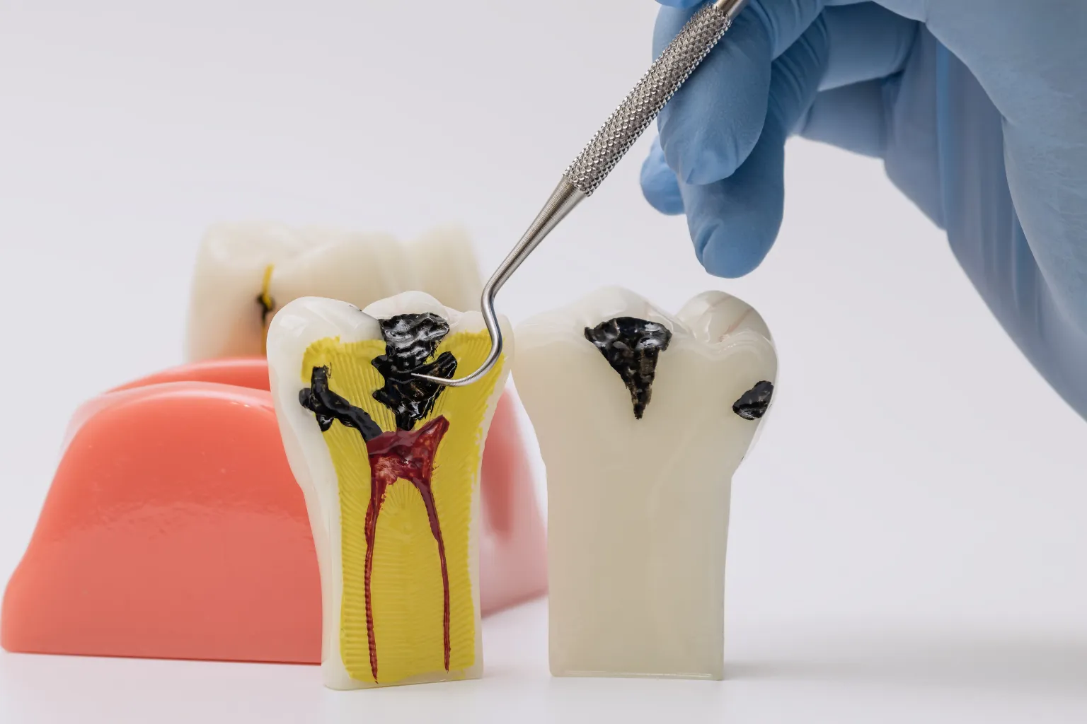 tooth anatomy inflamed pulp nerve pain tooth anatomy inflamed pulp nerve pain